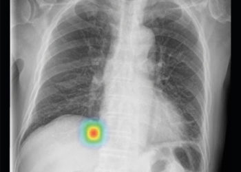 Lunit INSIGHT CXR detects findings and provides abnormality score on a chest X-ray image. (Photo  © Lunit)