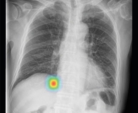 Lunit INSIGHT CXR detects findings and provides abnormality score on a chest X-ray image. (Photo  © Lunit)