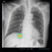 Lunit INSIGHT CXR detects findings and provides abnormality score on a chest X-ray image. (Photo  © Lunit)